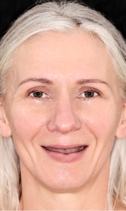Complex smile patient