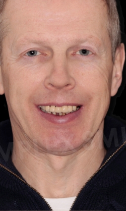 Complex smile patient